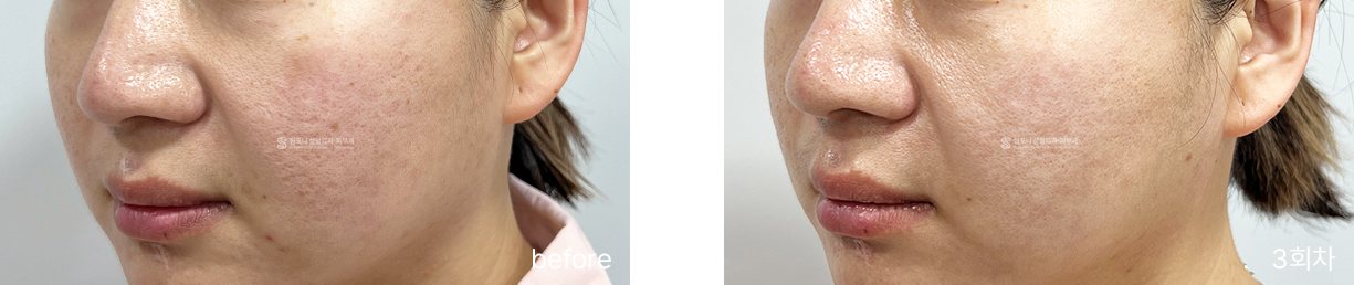 Acne scarring · before → 3 sessions