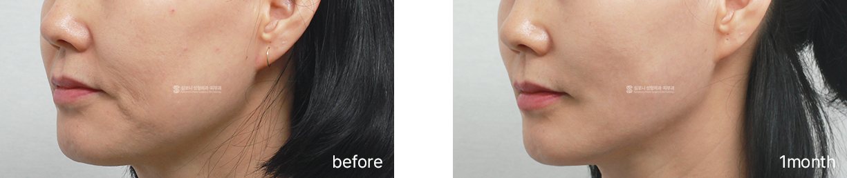Lower face and jawline · before → 1 month