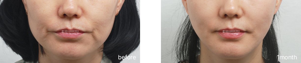 Jawline, front view · before → 1 month